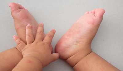 Baby swollen best sale hands and feet