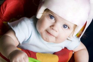 Plagiocephaly